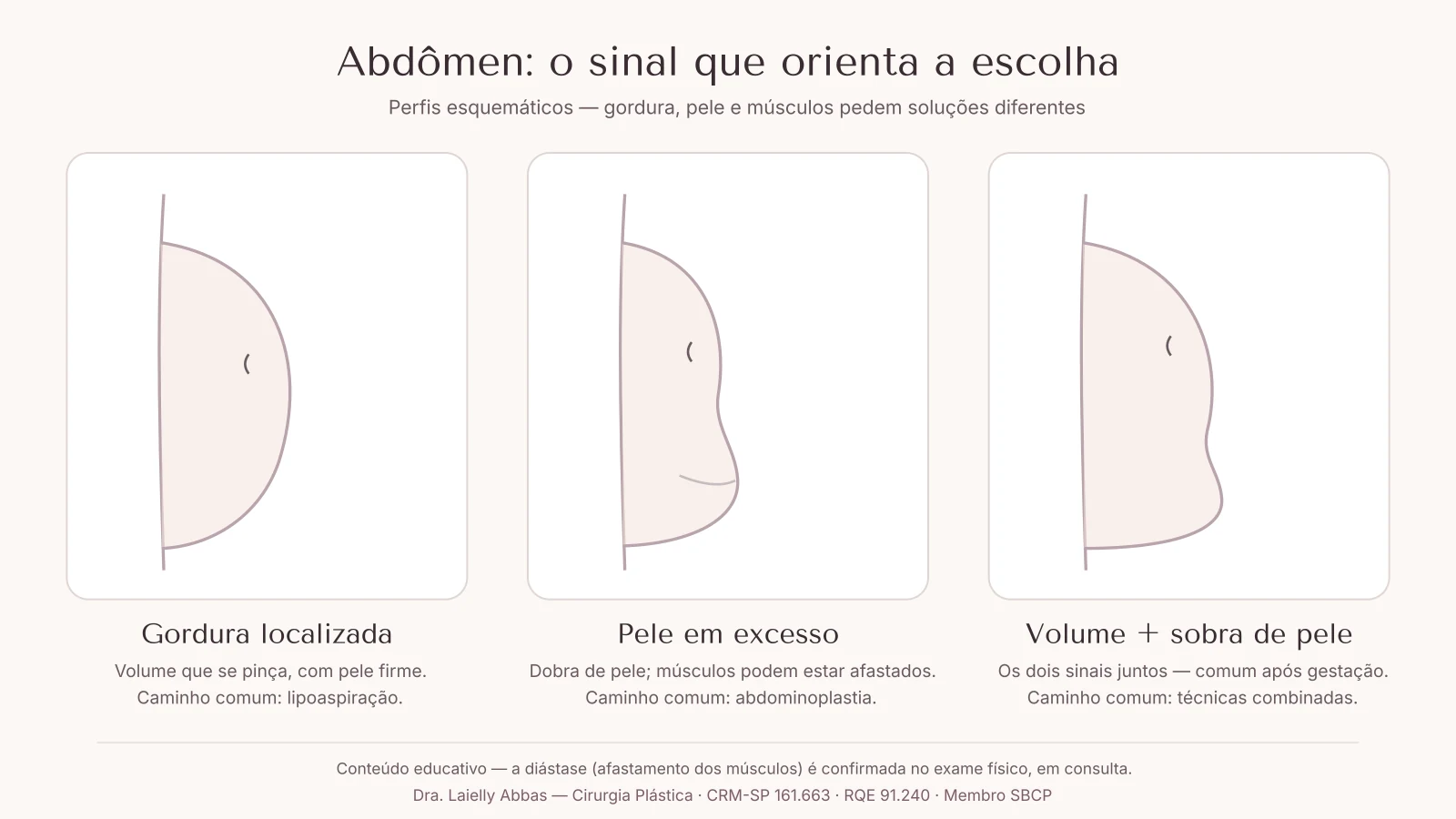 Três perfis esquemáticos de abdômen: gordura localizada, pele em excesso com dobra e a combinação dos dois sinais