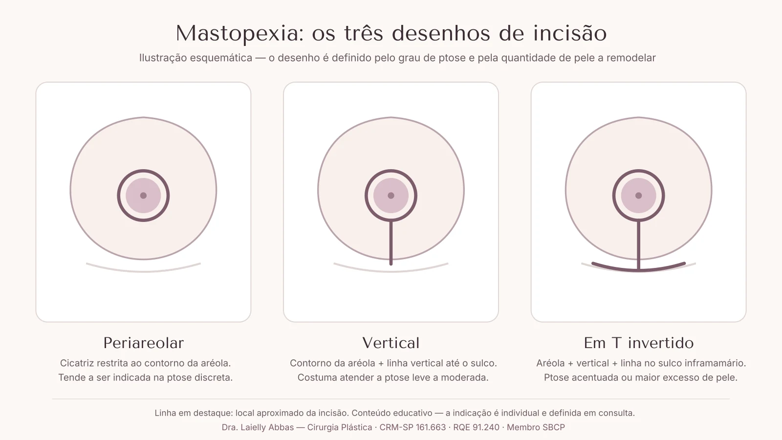 Diagrama esquemático dos três desenhos de incisão da mastopexia: periareolar, vertical e em T invertido