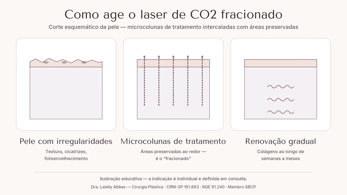 Corte esquemático da pele em três painéis: superfície irregular, microcolunas de tratamento fracionado e pele renovada com estímulo de colágeno