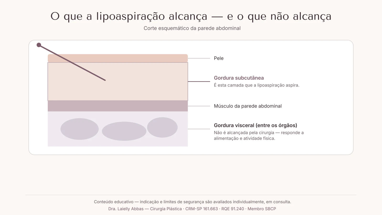 Corte esquemático da parede abdominal mostrando pele, gordura subcutânea alcançada pela cânula, músculo e gordura visceral não alcançada