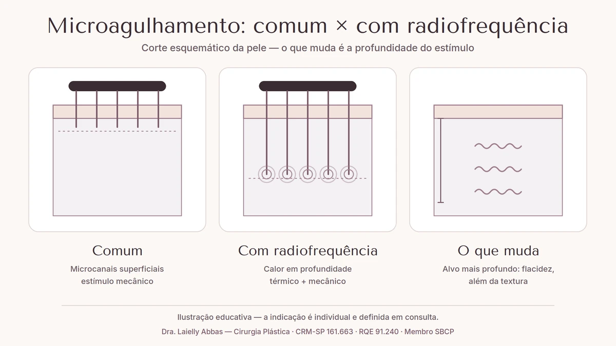 Corte esquemático comparando o microagulhamento comum, com agulhas superficiais, e o microagulhamento com radiofrequência, com energia em camadas mais profundas