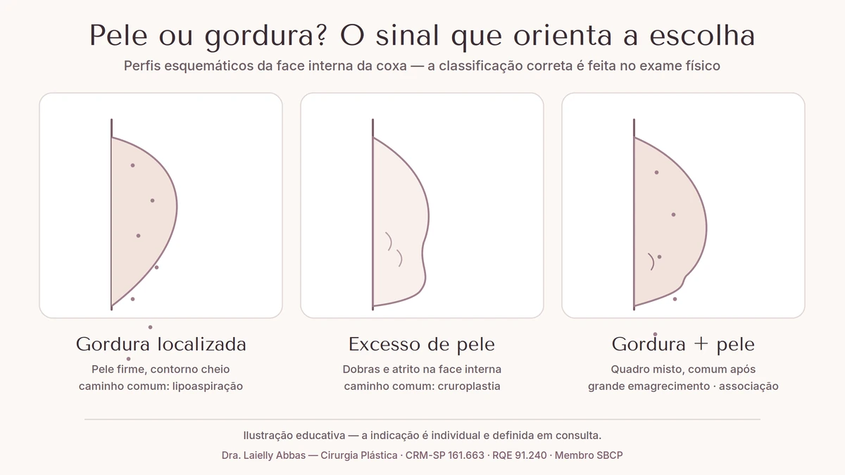 Ilustração esquemática comparando três situações da face interna da coxa: gordura localizada com pele firme, excesso de pele com dobras e quadro misto