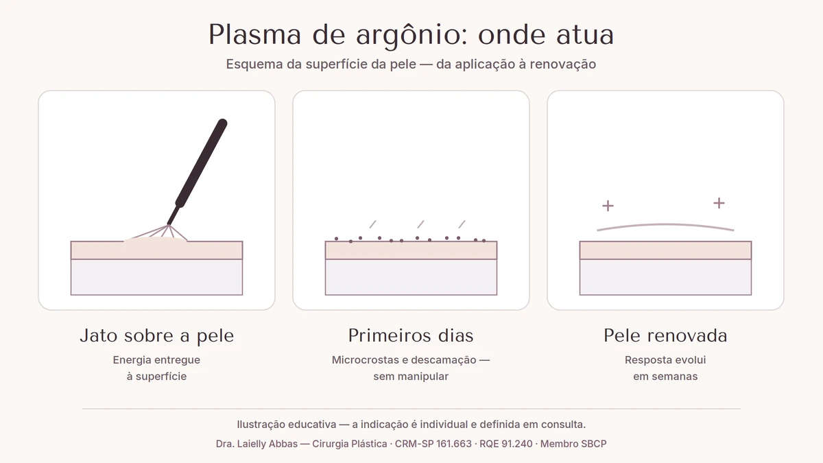 Esquema em três painéis: jato de plasma aplicado sobre a pele, fase de microcrostas nos primeiros dias e superfície renovada