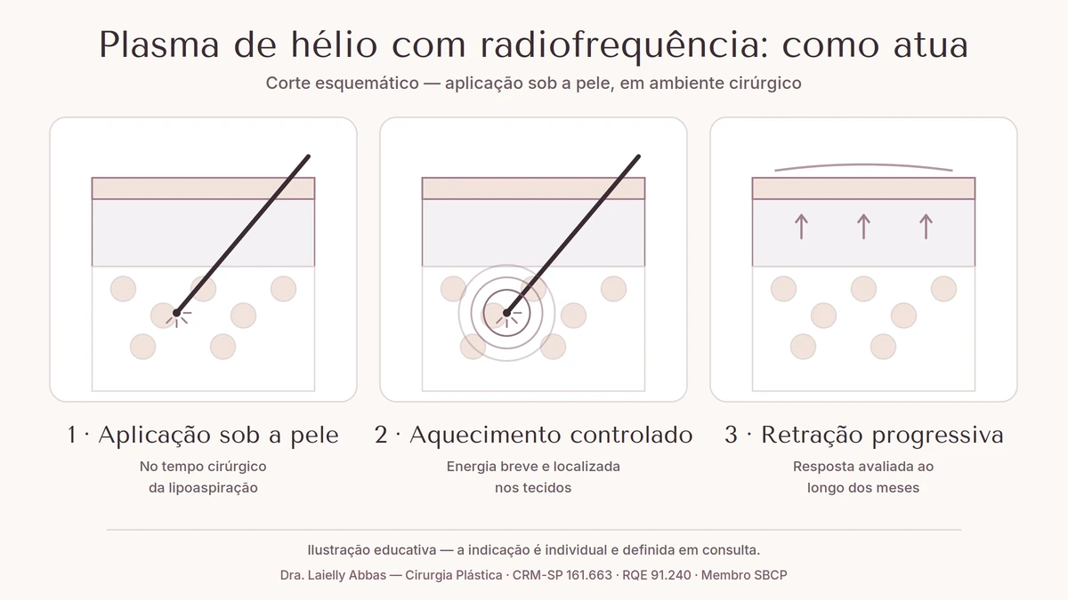 Corte esquemático em três etapas: cânula aplicando energia sob a pele, aquecimento controlado dos tecidos e retração progressiva da pele