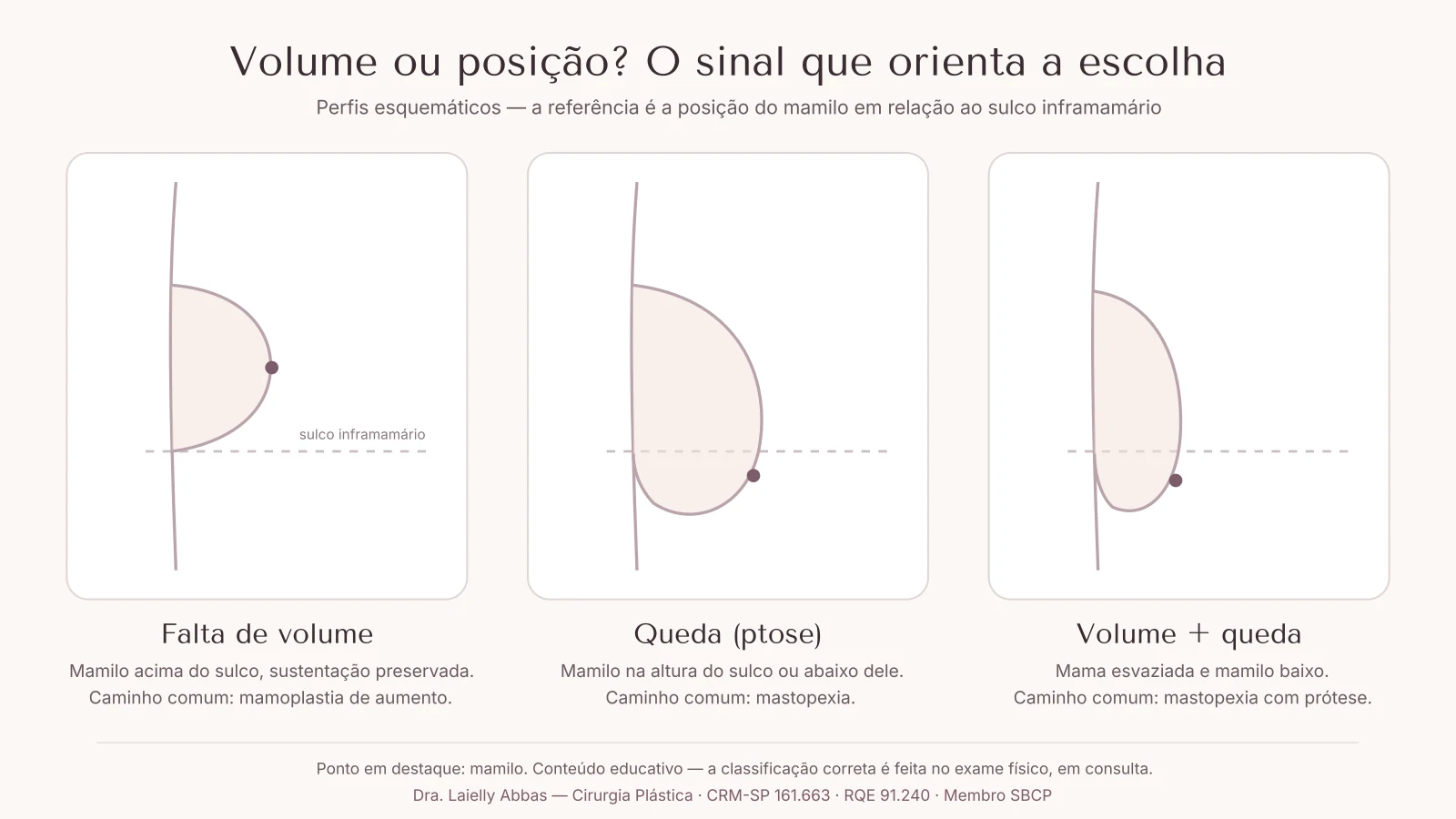 Ilustração esquemática em perfil comparando três situações: falta de volume com mamilo acima do sulco, queda com mamilo abaixo do sulco, e volume reduzido com queda